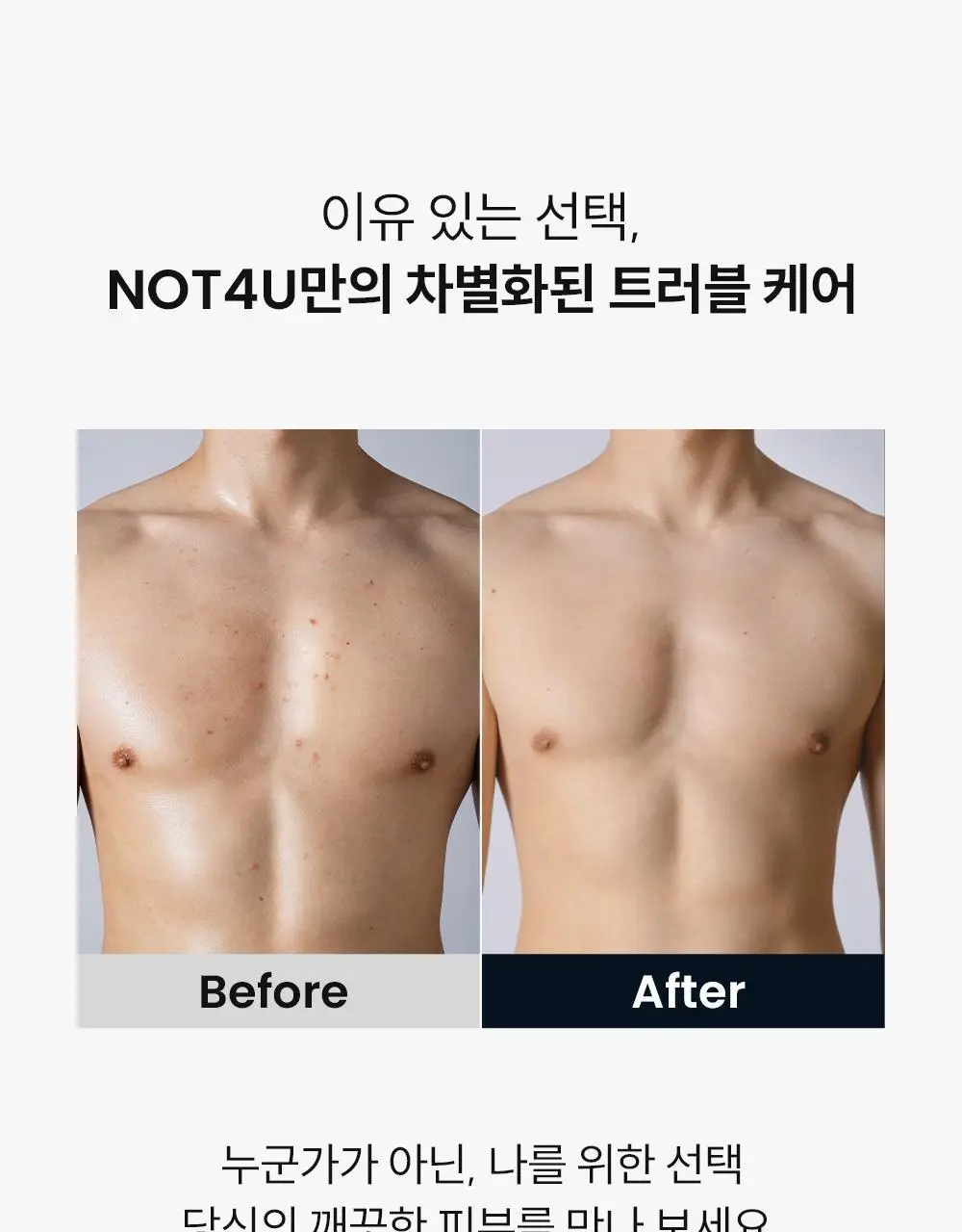 [등드름/체취케어] 낫포유 지성피부전용 등드름/가드름 클리어 바디미스트 포맨 200ml 상세페이지 25